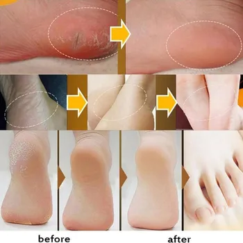 33 g Tradicionalni Kitajski Olje Anti-Sušenje Crack Foot Cream Pete Krekirana Repair Krema za Odstranjevanje Odmrle Kože, Roke, Noge, Nego Stopala Masko